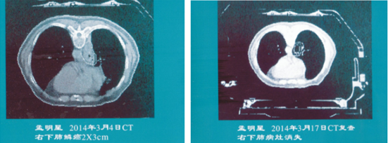 中西医结合治癌第一人高国俊教授 引领国际治癌前行之路(图3) 中西医结合治癌第一人高国俊教授 引领国际治癌前行之路(图3)