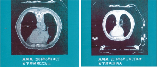 人民的好医生 中西医治癌专家苏州大学附一院名仕医院高国俊教授(图7)