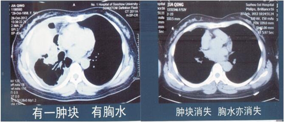 人民的好医生 中西医治癌专家苏州大学附一院名仕医院高国俊教授(图6)