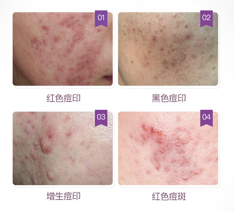 公认好用的祛痘印好物，herbsense贺柏圣淡印修复片(图2)