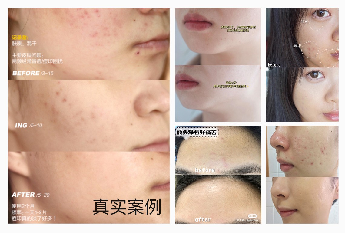 公认好用的祛痘印好物，herbsense贺柏圣淡印修复片(图6)